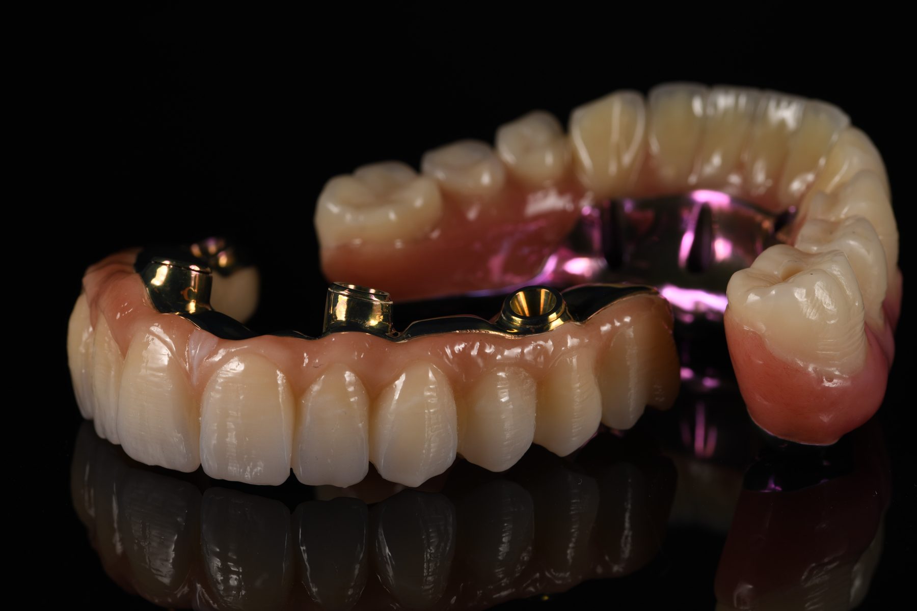 Implantatgetragene Brücke nach dem All-on-X-Konzept aus dem Dentallabor Holistic Smile Design