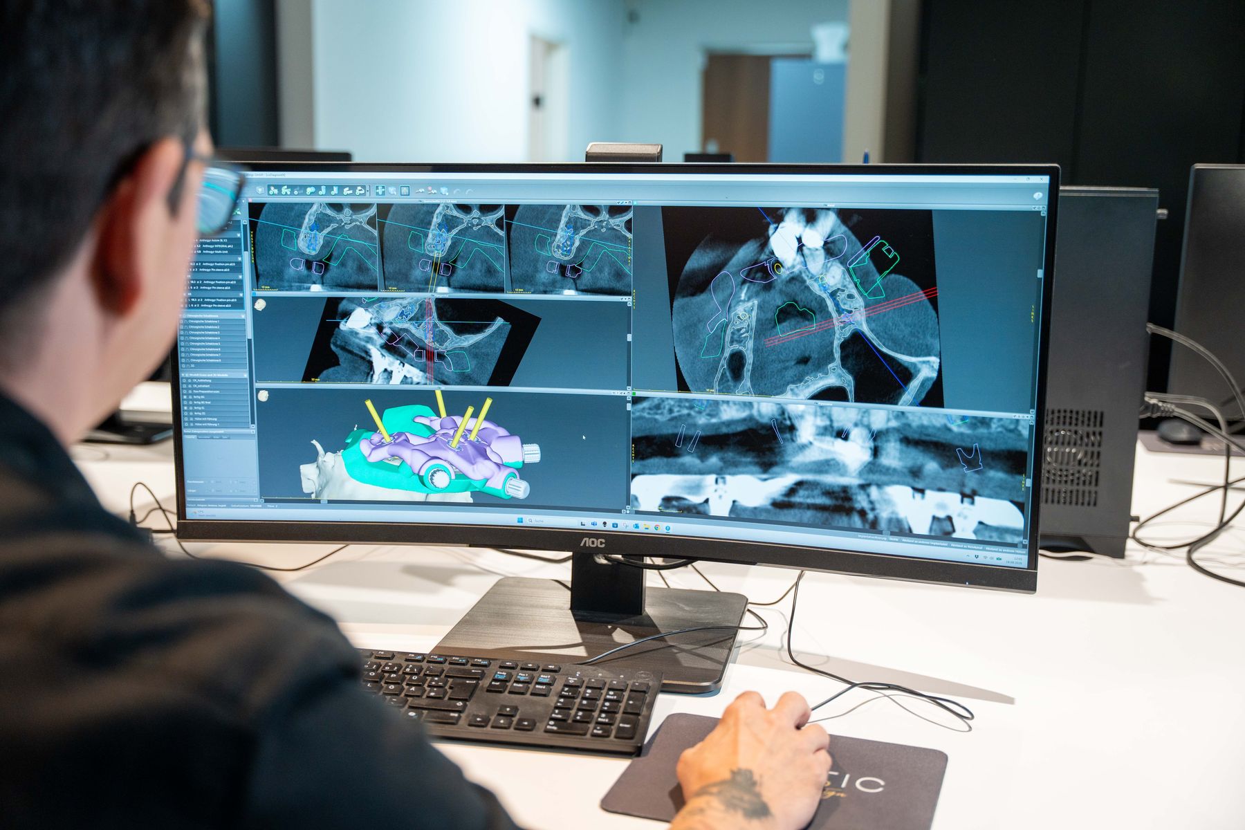 Zahntechniker plant eine Implantatversorgung am Bildschirm in der CAD-Software
