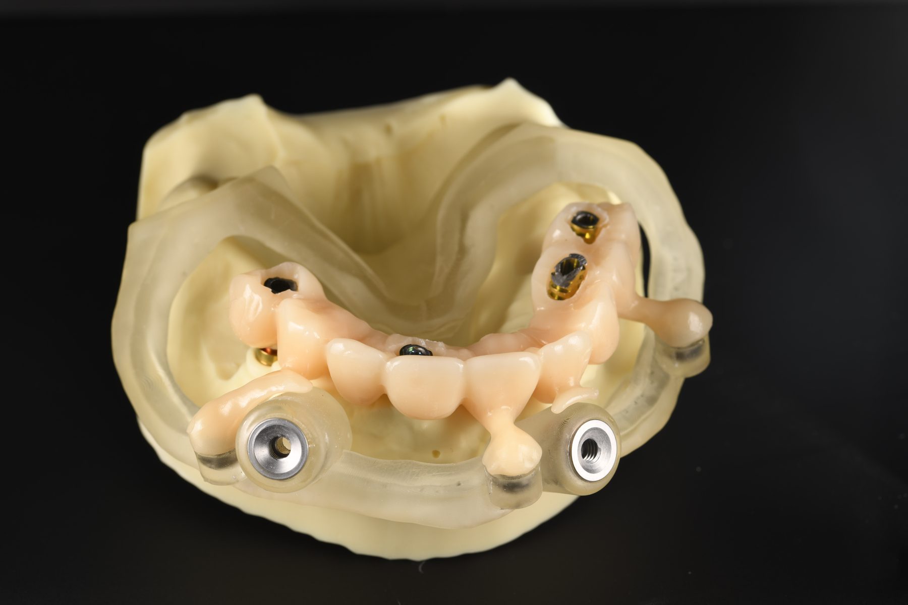 Implantatschablone mit Provisorium auf dem Modell