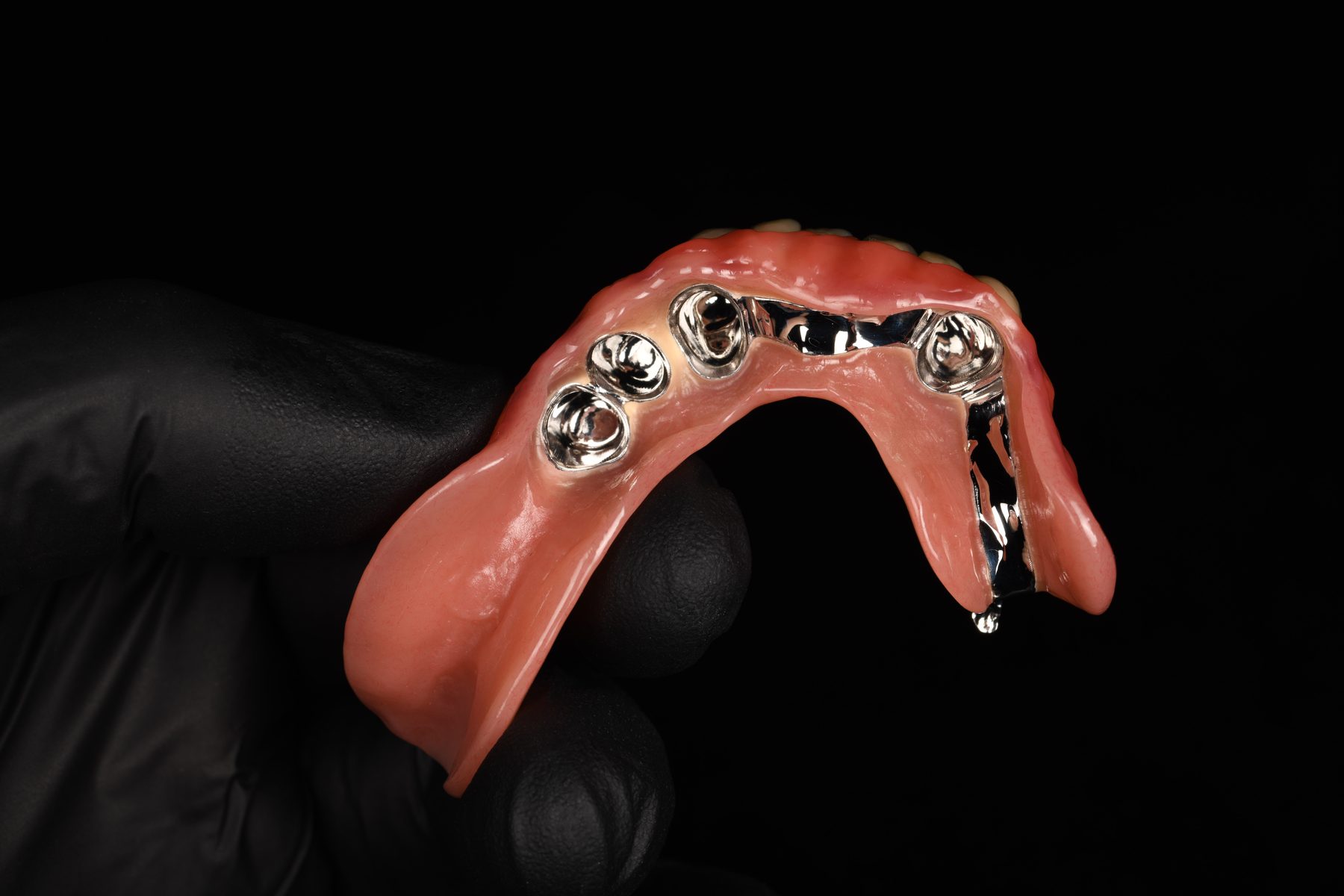 Teleskoparbeit aus dem Dentallabor Holistic Smile Design, Ansicht der Innenseite mit Teleskopen