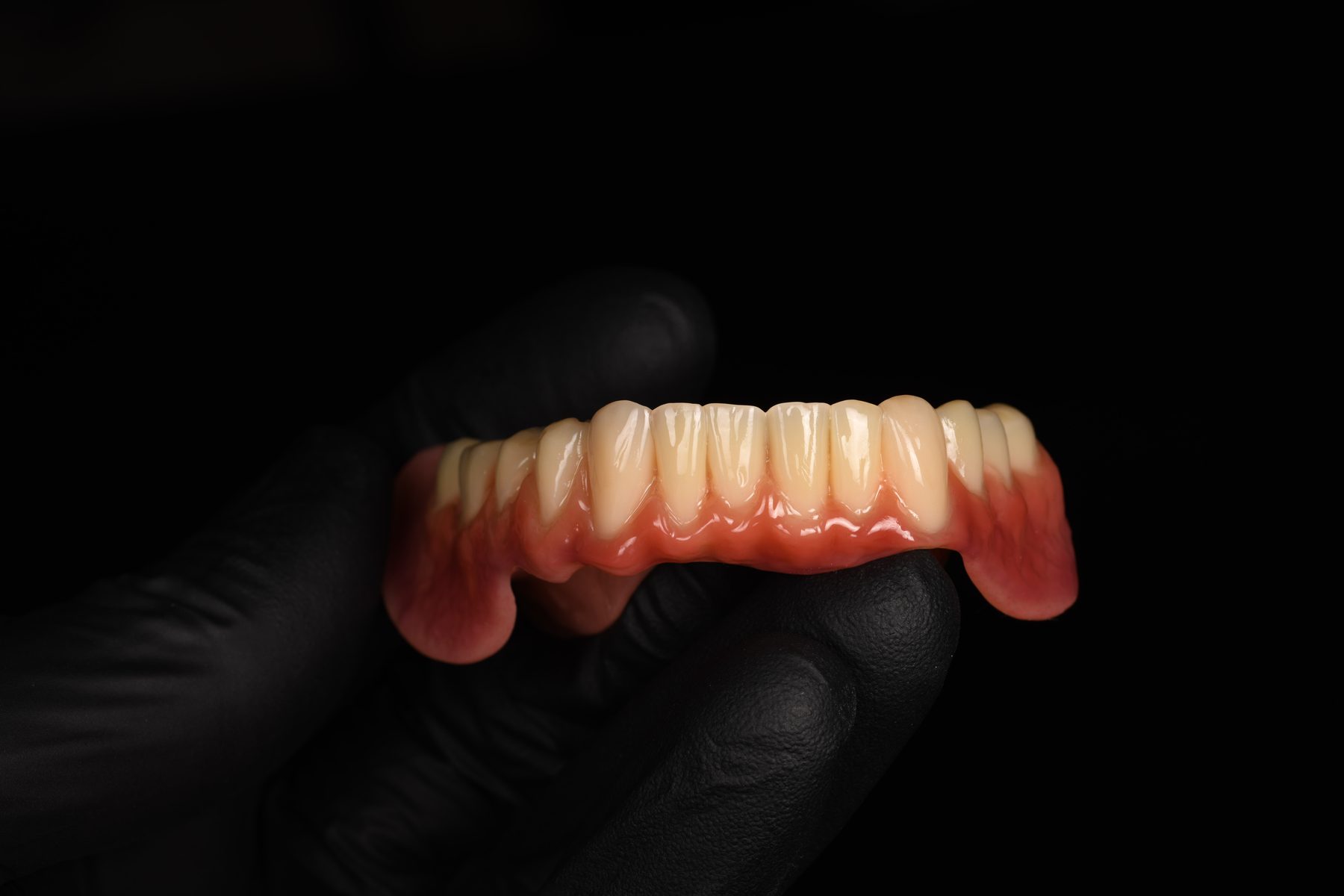 Fertige Teleskoparbeit aus dem Dentallabor Holistic Smile Design in Norderstedt