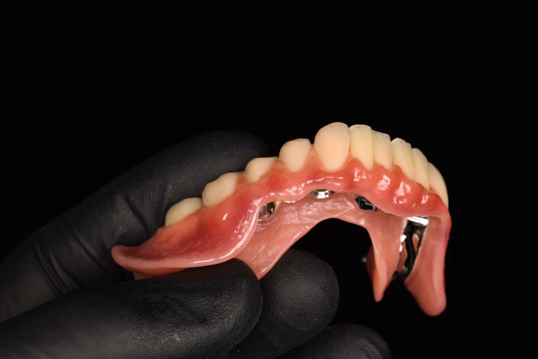 Teleskoparbeit von Holistic Smile Design in der Seitenansicht